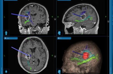 Caltanissetta, intervento neurochirurgico con l’aiuto della trattografia