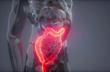 Stenosi diverticolare, diagnosi e intervento di Papa Francesco