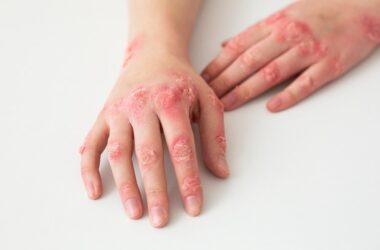 Salutequità e Apiafco “La psoriasi entri nel Piano Nazionale Cronicità”